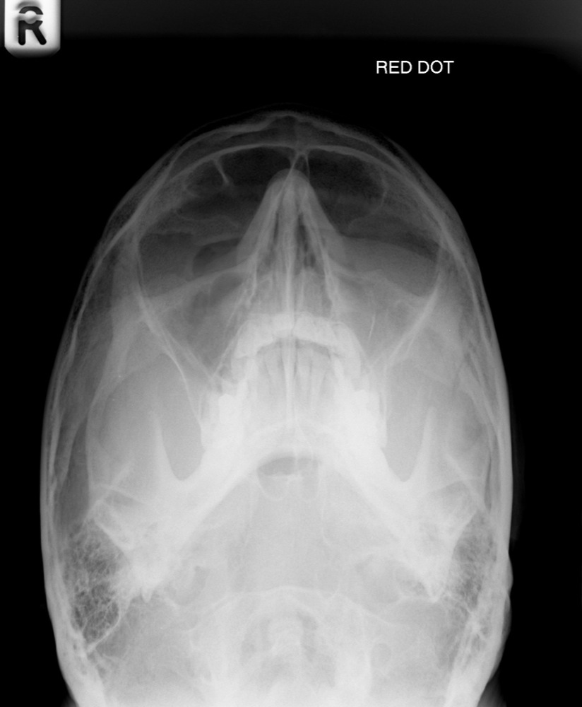 Zygomatic Arch Radiograph